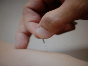 針灸治療頸椎病的原理與實(shí)踐