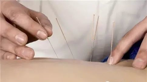 針灸減肥的三大常見誤區